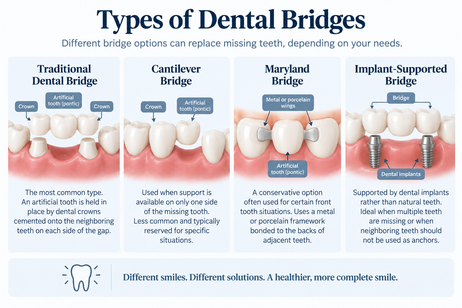 Types of Dental Bridges — diagram comparing traditional, cantilever, Maryland, and implant-supported bridges