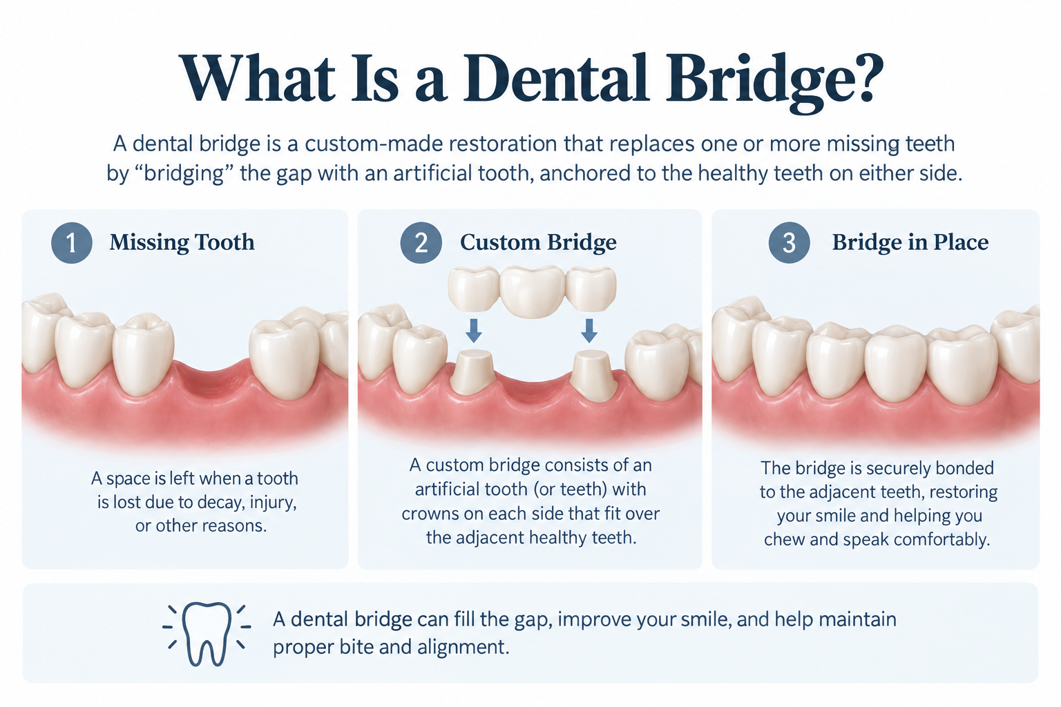 What Is a Dental Bridge — three-step diagram showing missing tooth, custom bridge, and bridge in place
