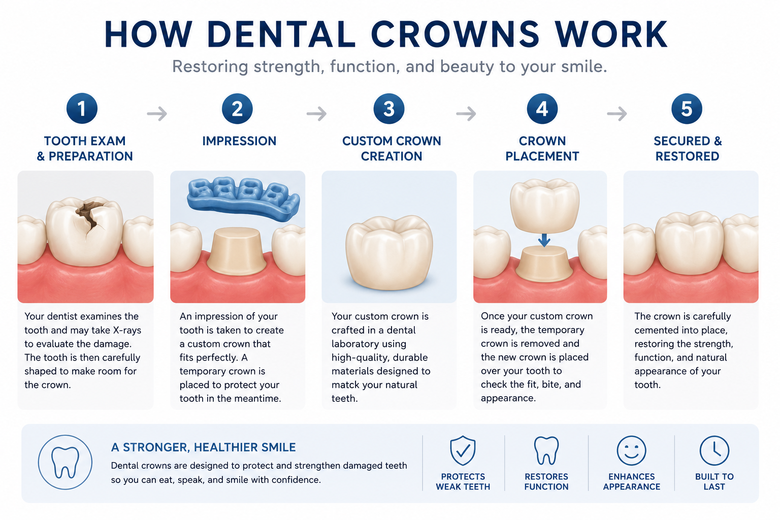 How dental crowns work — 5-step process diagram showing tooth preparation, impression, custom crown creation, placement, and final restoration