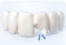 Can Cosmetic Dentistry Fix Chipped Teeth?