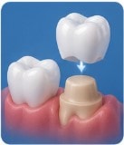 Dental crown appointment timeline and process