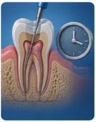 How Long Does a Root Canal Take?