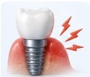 What Causes Implant Failure?