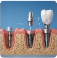 The Step-By-Step Dental Implant Process