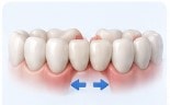Can Invisalign Straighten Crowded Teeth?
