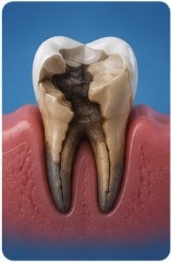 When Is a Tooth Beyond Saving?