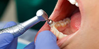 Teeth Cleaning Buckhead, GA